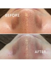 ポピン(POPIN)/≪毛穴洗浄≫アクアピール１回