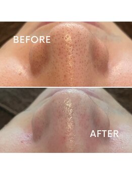 ポピン(POPIN)/≪毛穴洗浄≫アクアピール1回