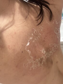 エレ(ele)/ベリっと剥ける背中ハーブ◎