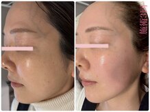 リアンプラベートサロン(Lien)の雰囲気（最新プラズマでキュッとリフトアップ！もう悩まない美肌へ）