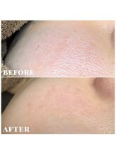 シェソワ(Chez soi)/頬の毛穴もキレイになります