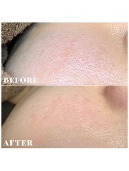 シェソワ(Chez soi)/頬の毛穴もキレイになります