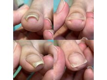 日本トップクラスの巻き爪・深爪・変形爪の補正実績店