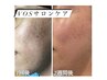 【肌質改善で話題♪ニキビケア/凹凸/毛穴の黒ずみ・開き】VOSサロン毛穴ケア