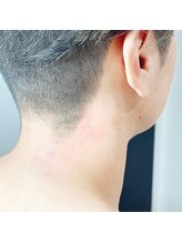 スムースラボ(Smooth LABO)/襟足のワックス脱毛