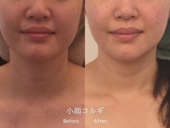 ヘアーアンドエステティック ヴェリス(hair&esthetic Velis)/小顔コルギ