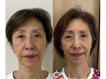 せせらぎ鍼灸院/目に光が宿る鬼美容鍼