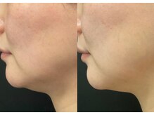 ティービーコジマ T・B・KOJIMA/レモンボトル　二重顎