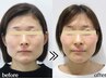 ◆エラ張り徹底改善!!◆憧れのVライン小顔へ!【小顔美顔+首肩】/通常¥12,300