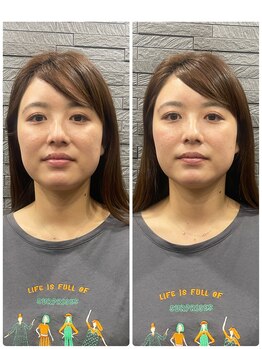 長寿鍼灸院 長寿整骨院/ハリネズミ女優美容鍼効果★