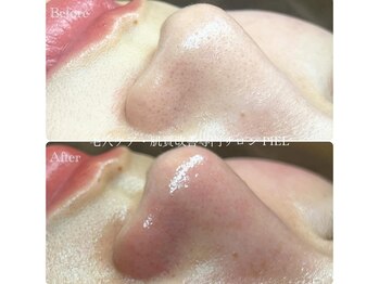 ピエル 北千住店(PIEL)/毛穴エクストラクションで美しく