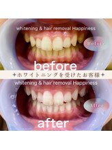 ハピネス 広島並木通り店(Happiness)/ホワイトニングBefore→After