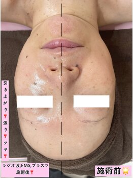 エスポワール(Espoir)/ラジオ波+EMS+プラズマ☆