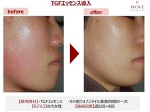 ブリエ/美容皮膚科監修エステ美顔導入器