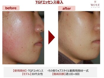 ブリエ/美容皮膚科監修エステ美顔導入器