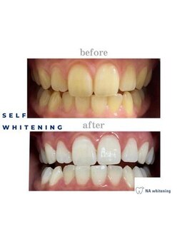 NA ホワイトニング 川崎溝の口店/ホワイトニング/川崎/溝の口