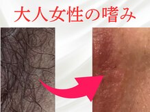 ナース監修VIO脱毛♪