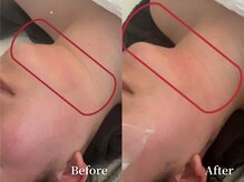 アストリエ グレース 相模大野(Astorie Grace)/脂肪分解効果でスッキリ