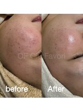 オフオルファヴォリ(OF Olu:Favori)/before after