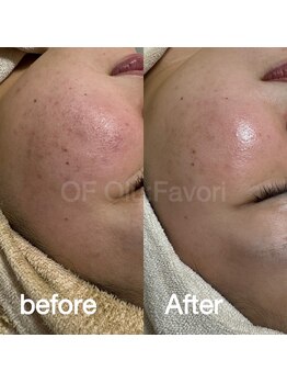 オフオルファヴォリ(OF Olu:Favori)/before after