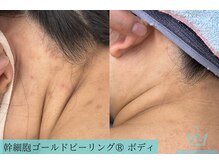 リメイククリニカルビューティー(Remake clinical beauty)/【施術症例】幹細胞GP