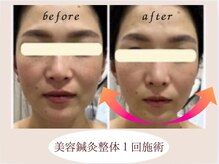 JJ夙川はり灸院の雰囲気（フェイスラインがスッキリ◎美容鍼未経験の方こそ是非当院で☆）