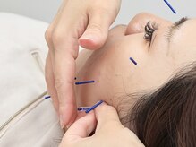 LCFユキ(LCF YUKI)/美容鍼灸 小顔/美容鍼/美容整体