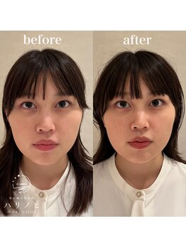 ハリノヒ 大阪院/小顔が実現!骨格から整う美容鍼