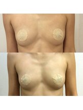 ルミエール(Lumiere)/【倉敷市】バストアップ施術事例