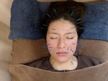 こじま 富雄団地接骨院/ヒト幹細胞美容鍼