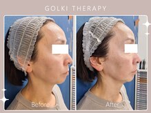 シロカネ イオンタウン西熊本店(SHIROKANE)/韓国式小顔コルギ☆