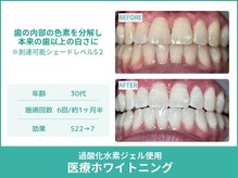 クレア(Crea)/【歯のホワイトニング症例写真】