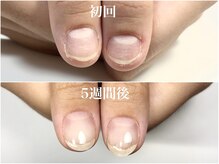 5週間後の変化 フィルイン