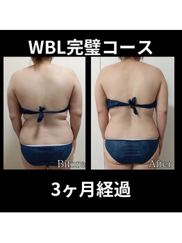 ホワイトビューティーラボ(White Beauty Lab)/【痩身】WBL完璧コース