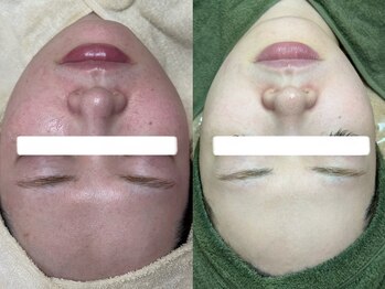 イベリス(Iberis)/ハーブピーリング/赤み改善