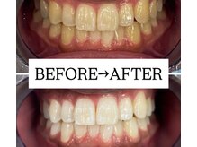 ホワイトニングサロン 宝塚/Before&After美白ホワイトニング