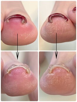 一宮巻き爪センター/巻き爪