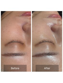 アスボーテ 月島(As Beaute’)/45%ヒト幹細胞導入60分の変化♪