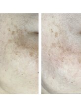 オンフリーク(ONFREEK)/BBL(最新光フェイシャル)