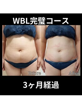 ホワイトビューティーラボ(White Beauty Lab)/【痩身】WBL完璧コース