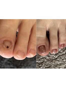 角質ケアができるサロン