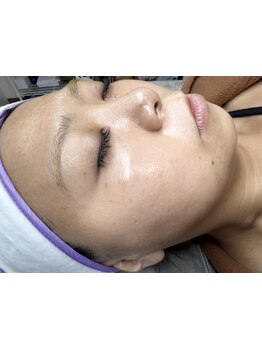 顔脱毛がしたい