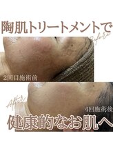 ルクー(RuCoeur.)/陶肌トリートメント前後写真♪