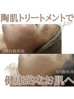 ルクー(RuCoeur.)/陶肌トリートメント前後写真♪