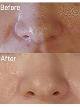 オン(on.)/【トロイピール】Before/After