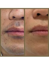 リアンジュ/ヒゲ脱毛の経過