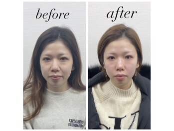 きらめき鍼灸治療院/美容鍼を一年間続けた結果!