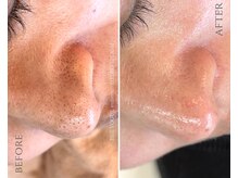 ザ ヴォーグ(the VOGUE)/毛穴洗浄で詰まりを撃退！