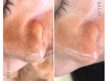 ザ ヴォーグ(the VOGUE)/毛穴洗浄で詰まりを撃退！