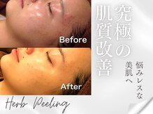 プレステージ 横須賀中央店/ピーリング◆ビフォーアフター